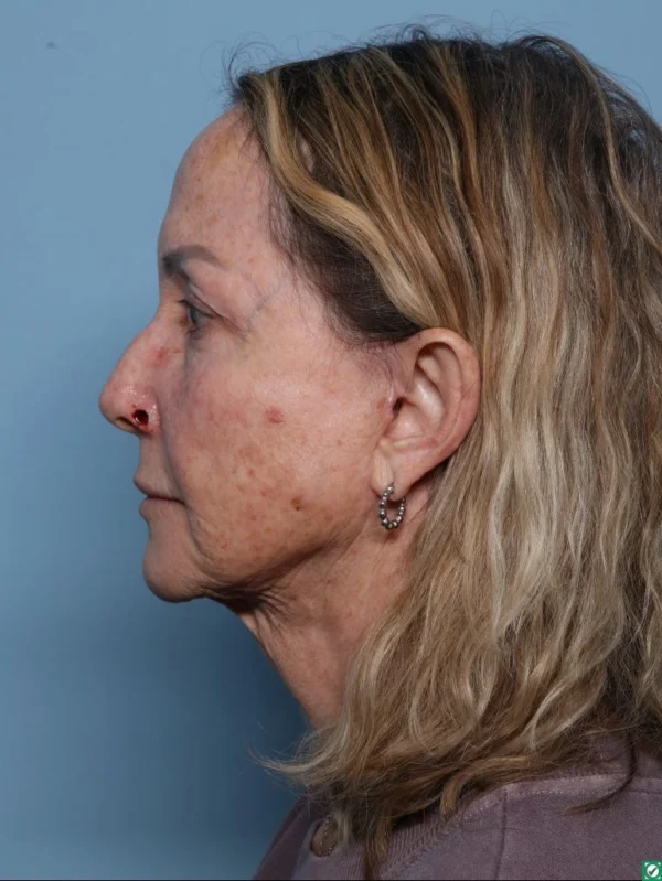 Skin Cancer Reconstruction