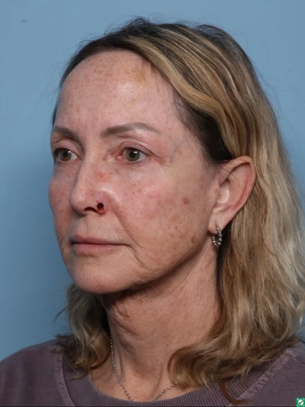 Skin Cancer Reconstruction