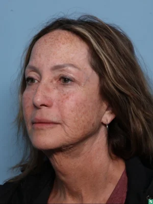 Skin Cancer Reconstruction