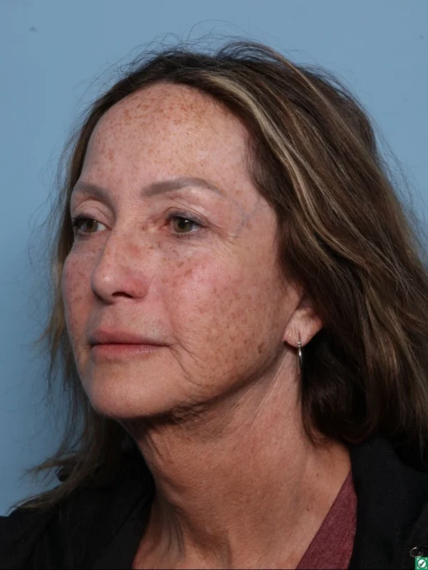 Skin Cancer Reconstruction