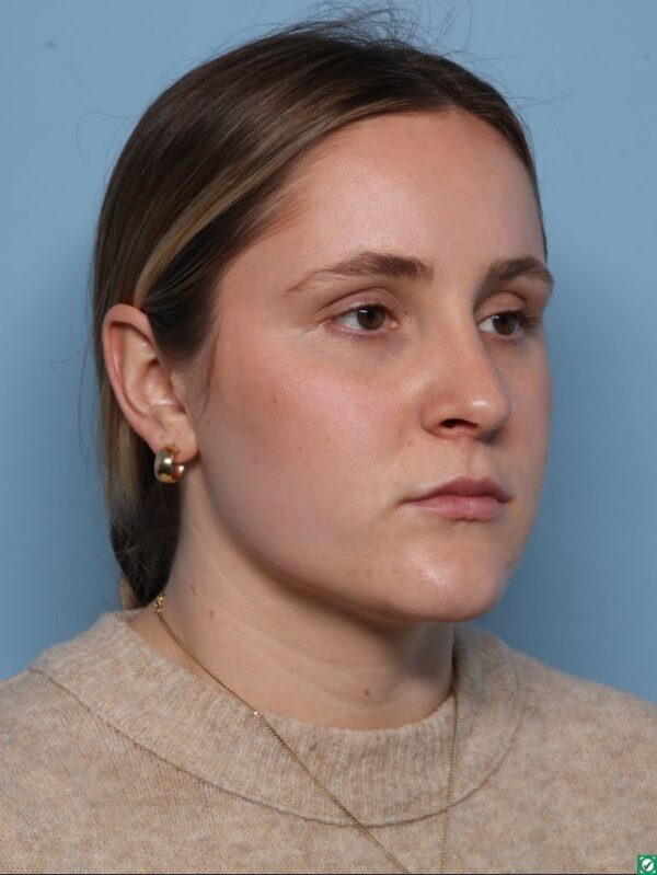 Rhinoplasty