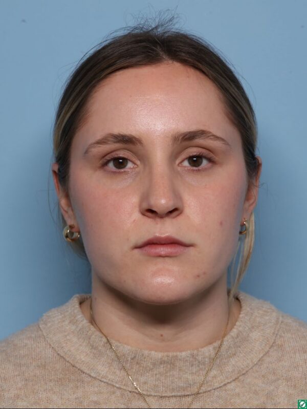 Rhinoplasty