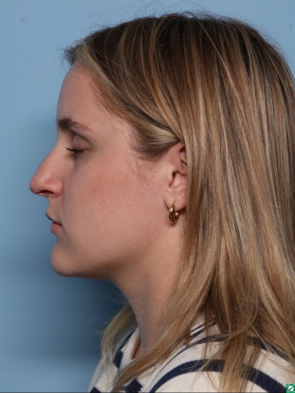 Rhinoplasty