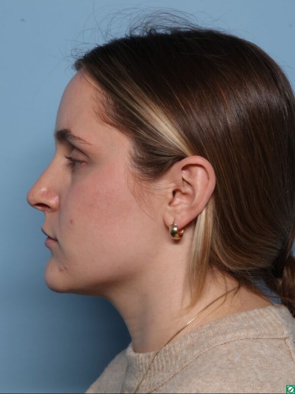 Rhinoplasty