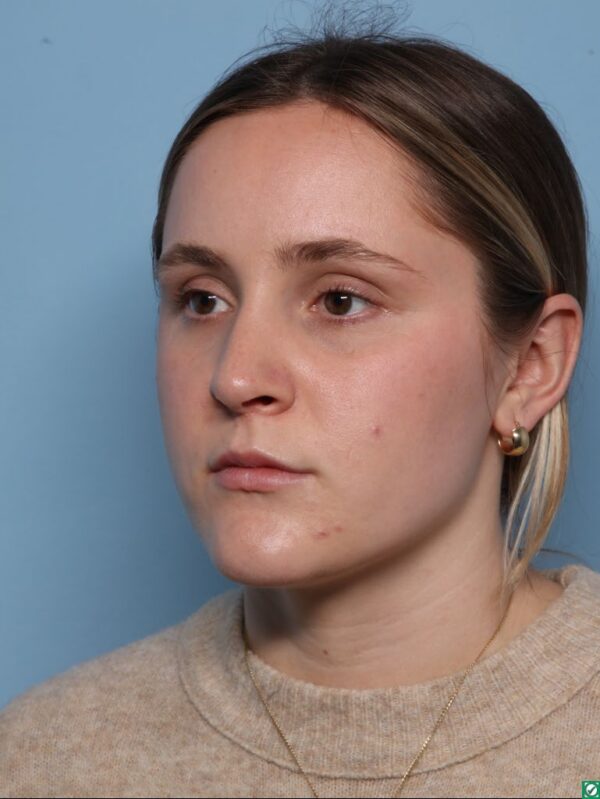 Rhinoplasty