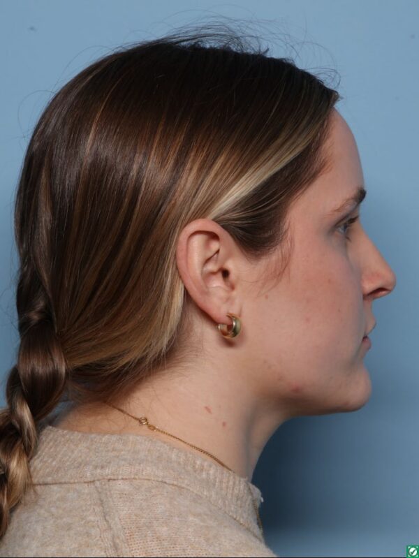 Rhinoplasty
