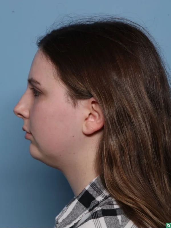Chin Augmentation