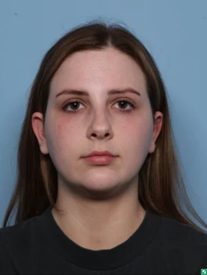Chin Augmentation