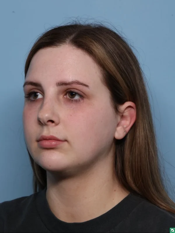 Chin Augmentation