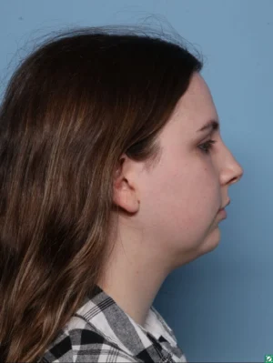 Chin Augmentation