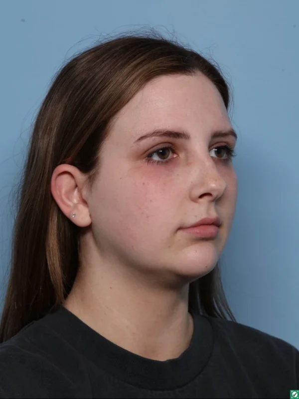 Chin Augmentation