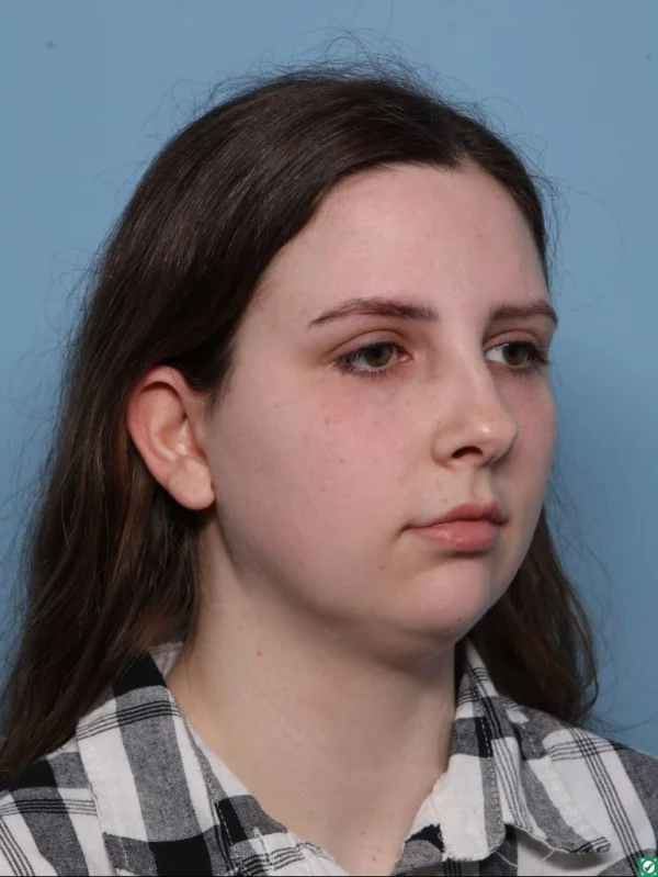 Chin Augmentation