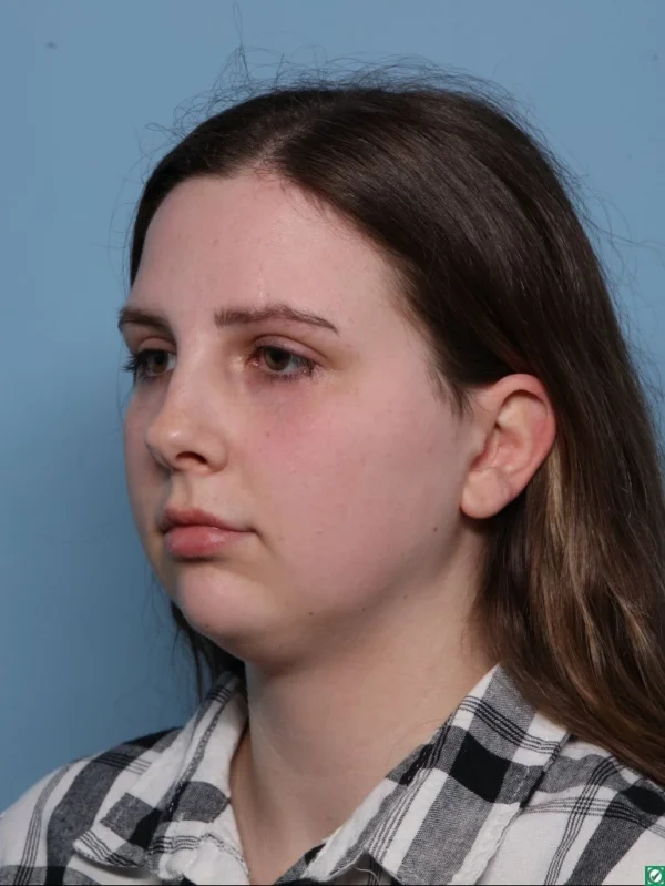 Chin Augmentation