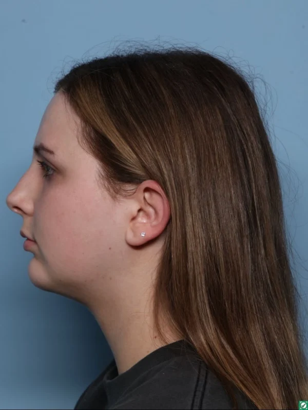 Chin Augmentation