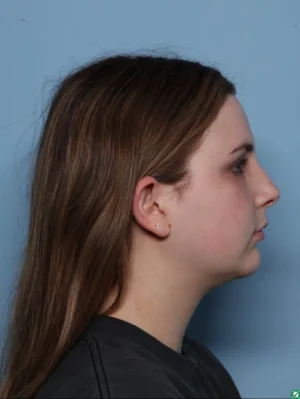 Chin Augmentation