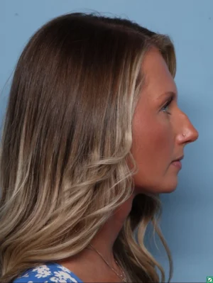 Rhinoplasty