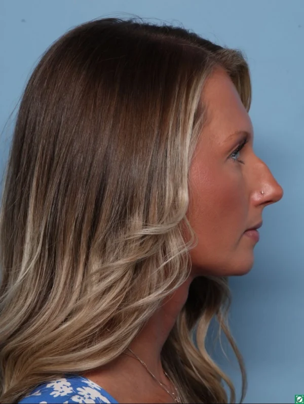 Rhinoplasty