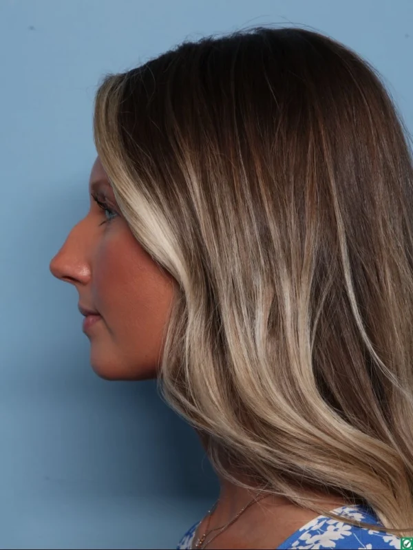 Rhinoplasty