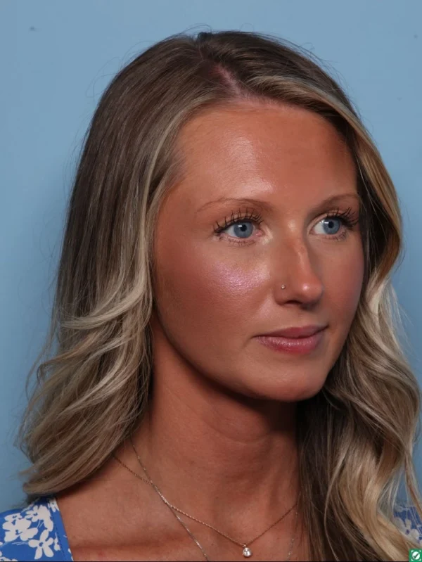 Rhinoplasty