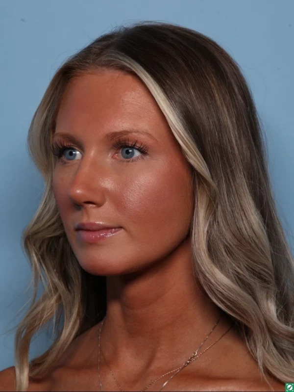 Rhinoplasty