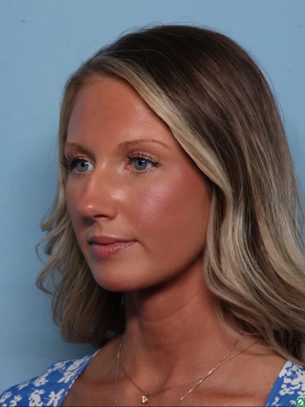 Rhinoplasty