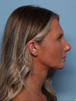 Rhinoplasty