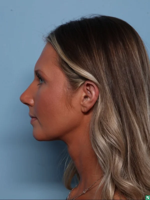Rhinoplasty
