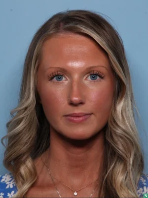 Rhinoplasty