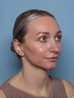 Facelift