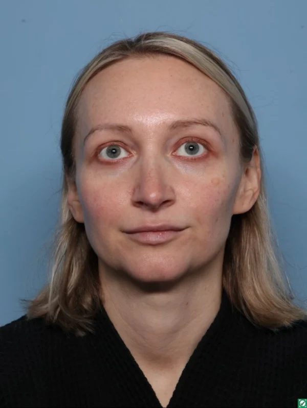 Facelift
