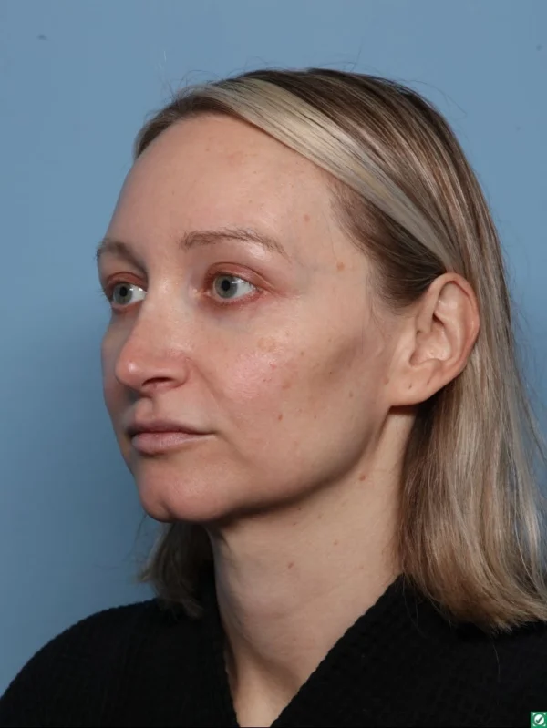 Facelift