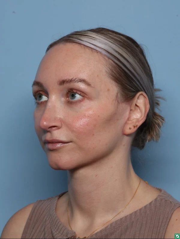 Facelift