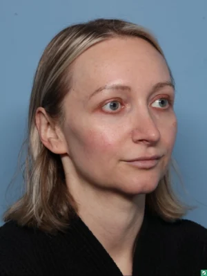 Facelift