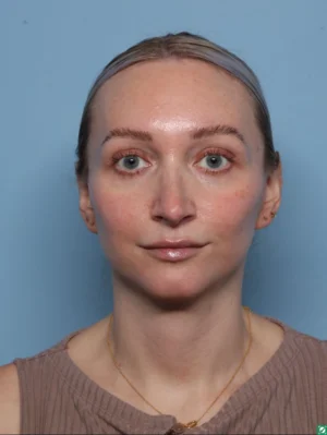 Facelift