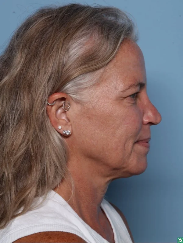 Upper Blepharoplasty