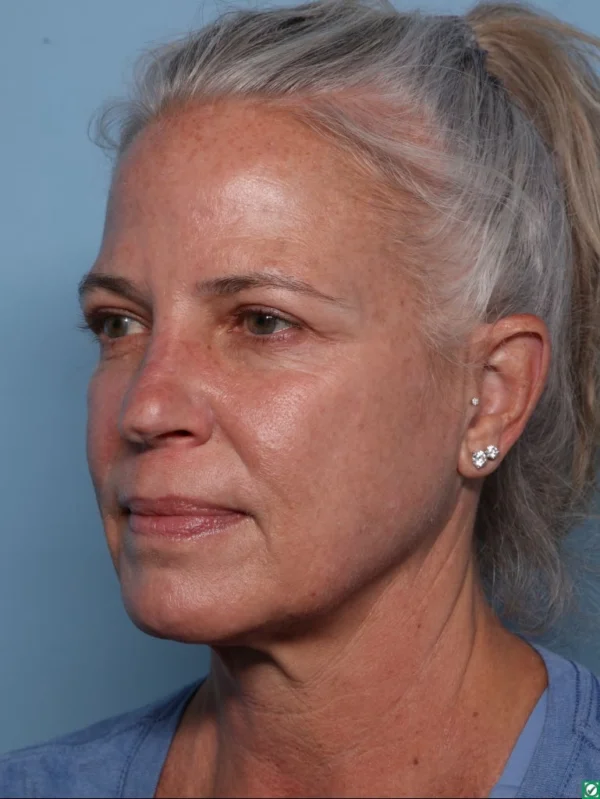 Upper Blepharoplasty