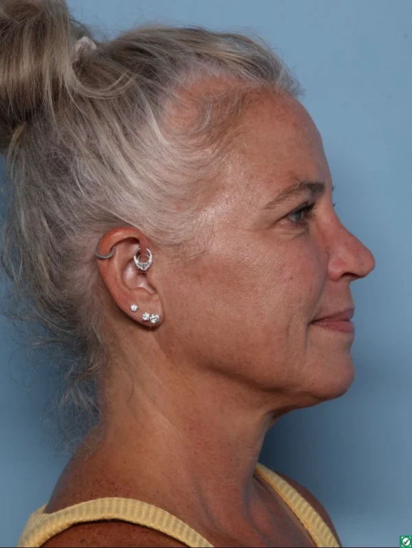 Upper Blepharoplasty