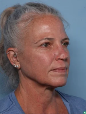 Upper Blepharoplasty