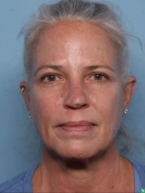 Upper Blepharoplasty