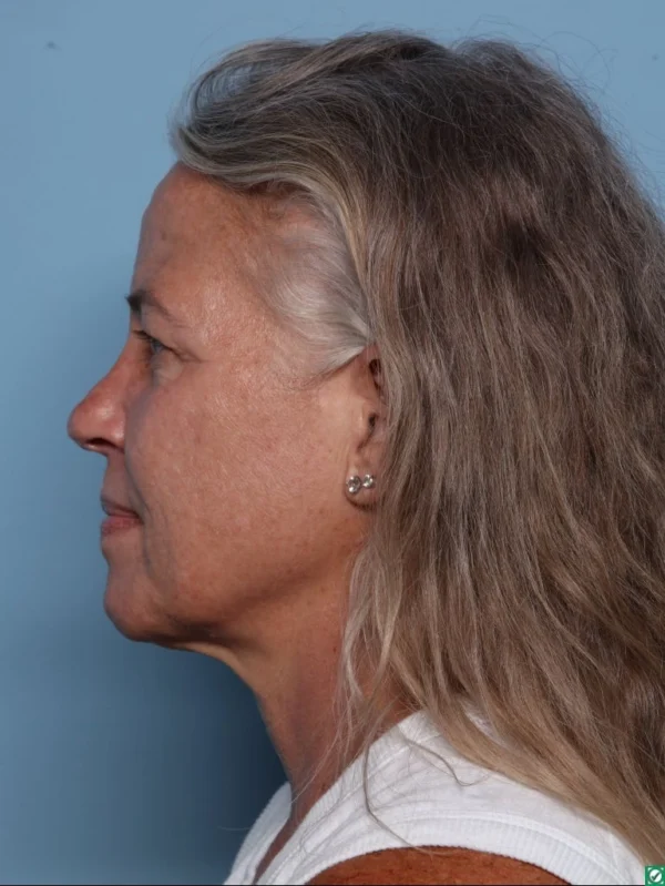 Upper Blepharoplasty