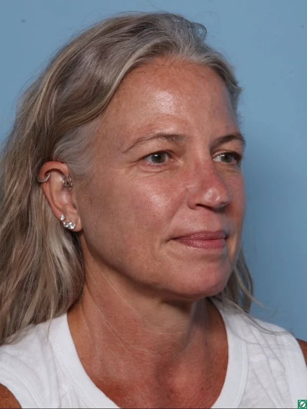 Upper Blepharoplasty