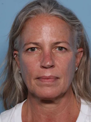 Upper Blepharoplasty