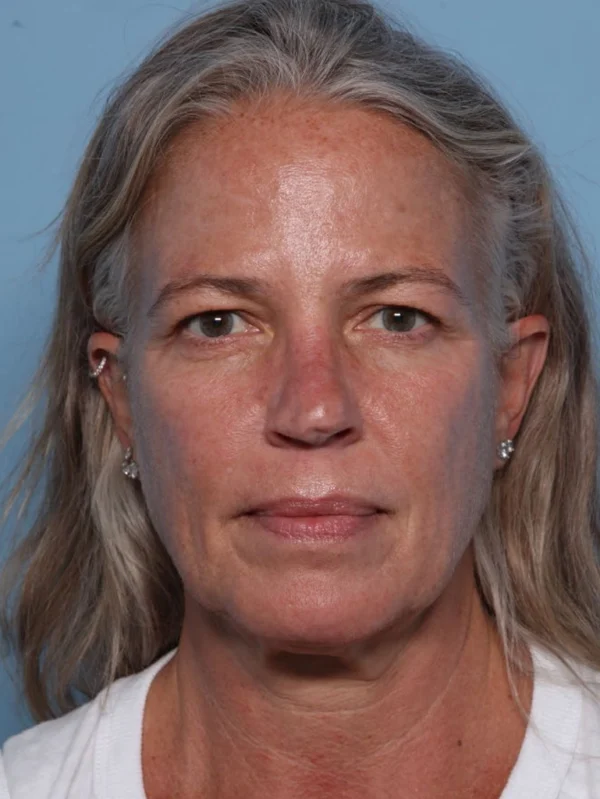 Upper Blepharoplasty