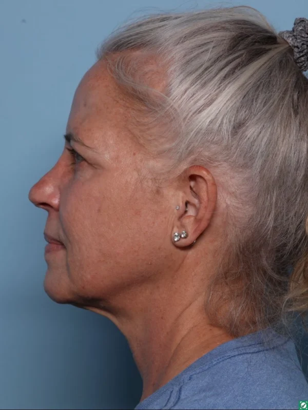 Upper Blepharoplasty