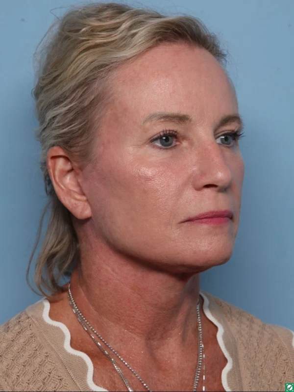 Facelift