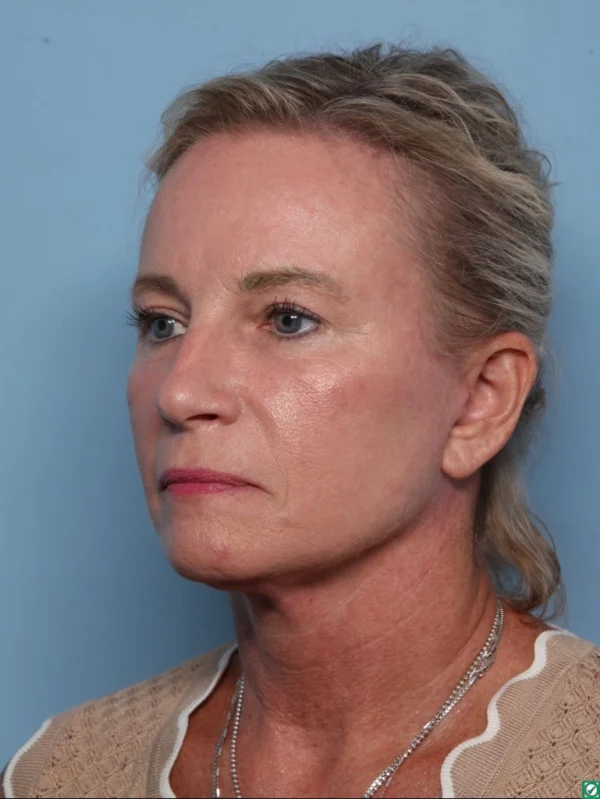 Facelift