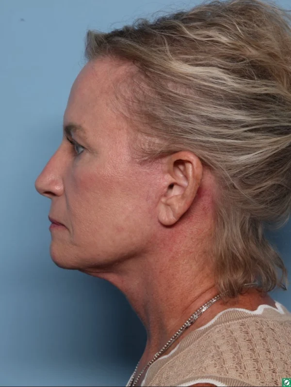 Facelift