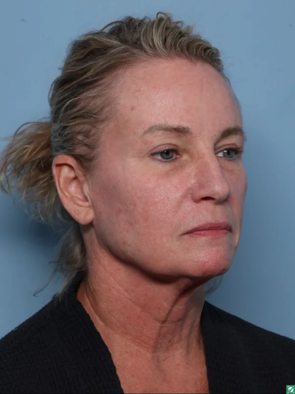 Facelift
