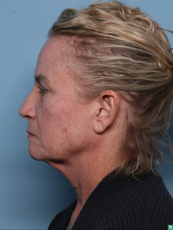 Facelift