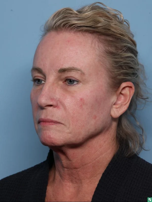 Facelift